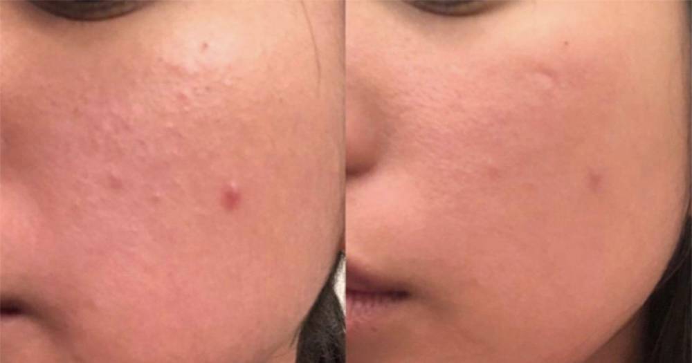 This Pain-Free Derma Roller Is Producing the Most Incredible Before and After Photos - www.usmagazine.com