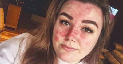 Nurse faces death threats from online trolls over severe skin condition - www.dailyrecord.co.uk