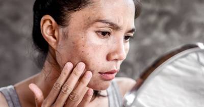 What is hyperpigmentation and how can you treat your skin? From serums to laser - www.ok.co.uk