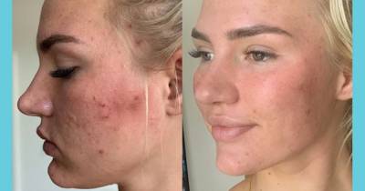 93% Felt More Confident in Their Skin After Using This Acne Clearing Gel - www.usmagazine.com