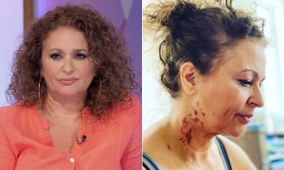 Loose Women's Nadia Sawalha shares update on horrific facial burn - hellomagazine.com