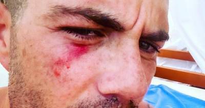 The Wanted's Max George shares bloodied selfie after diving accident which could have blinded him - www.ok.co.uk