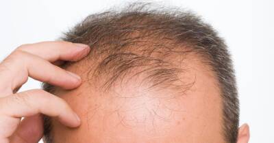 Hair loss appearing in Covid sufferers months after infection - www.dailyrecord.co.uk - USA - Indiana - Turkey