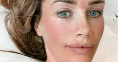 Love Island’s Laura Anderson gets ‘painful’ needle treatment in a bid to reduce sun damage - www.ok.co.uk - Dubai