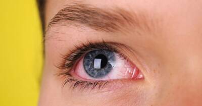 Omicron Covid symptoms on eyes and hair and when 'strange' signs appear - www.dailyrecord.co.uk - Scotland - USA