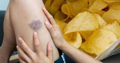 Blood clots: The 6 ‘beige' foods to avoid - will ‘wreak havoc' on your arteries - www.msn.com