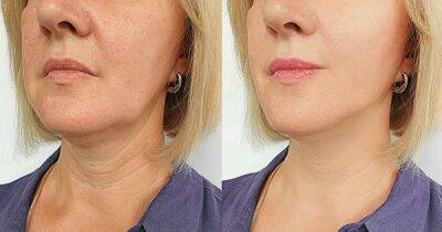 This Skin Treatment May Give You Face Lift Effects in Just 10 Minutes - www.usmagazine.com