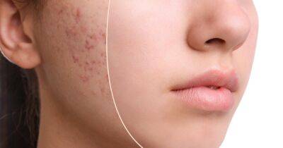This Invisible Acne Spot Treatment May Work in Just 4 Hours - www.usmagazine.com