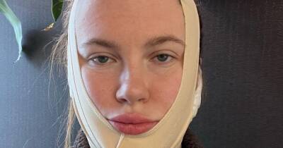 Alec Baldwin's daughter Ireland shares bandaged selfie after 'mini facelift' aged 26 - www.ok.co.uk - Ireland