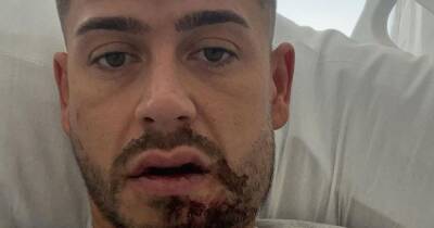Geordie Shore's Ant Kennedy left with broken jaw after 'unprovoked attack' in Ibiza - www.ok.co.uk - Spain - city San Antonio