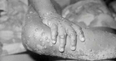 What is monkeypox - symptoms of virus spread by wild animals after UK case found - www.dailyrecord.co.uk - Britain - London - Nigeria