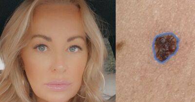 Scots mum 'diagnosed' own with skin cancer with app from smartphone - www.dailyrecord.co.uk - Scotland - USA