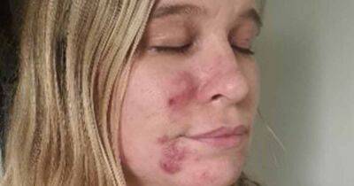 Mum felt 'like a monster' and hid her face from daughter when struck with cystic acne after Covid - www.manchestereveningnews.co.uk - Manchester