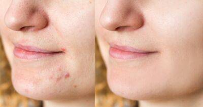 This Therapeutic Gel May Remove Acne Scars Dating Back to Your Teenage Years - www.usmagazine.com