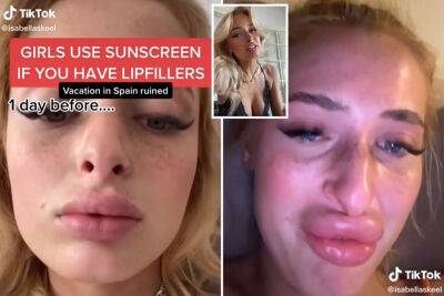 My lip fillers blew up after bad reaction to sunlight: Use sunscreen! - nypost.com - Spain