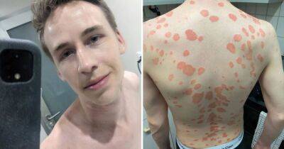 Man who ‘became a hermit’ after waking up covered in drop-shaped sores is ‘sassy’ again after drastic lifestyle change - www.manchestereveningnews.co.uk - Scotland - Manchester