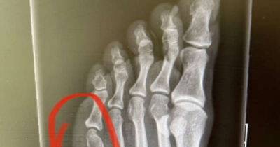 Coleen Rooney shares broken toe X-ray after claims she was ‘milking’ court moon-boot - www.msn.com
