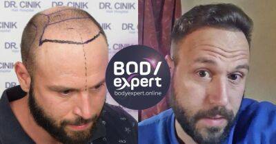 A hair transplant in Turkey could help with hair loss issues - www.manchestereveningnews.co.uk - Turkey