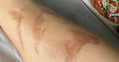 Traveller issues warning about surprise burn marks that can take years to heal - www.dailyrecord.co.uk - Australia - Indonesia