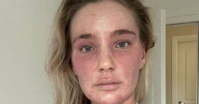 Scots woman no longer recognises herself in mirror due to burns from steroid creams - www.dailyrecord.co.uk - Scotland - Beyond