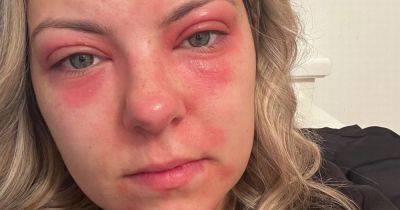 'I became a recluse after I was left with painful red sores all over my face' - www.manchestereveningnews.co.uk - Manchester - Beyond