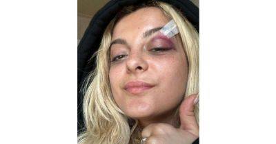 Singer shows black eye after being hit by phone during concert - www.msn.com - France - New York