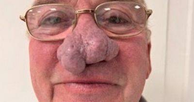 Scots grandad forced to pay to have huge nose growth removed and slams NHS for lack of help - www.dailyrecord.co.uk - Scotland - Beyond