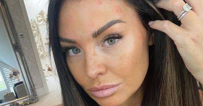 TOWIE's Jess Wright shares update on 'frustrating' psoriasis battle - www.ok.co.uk