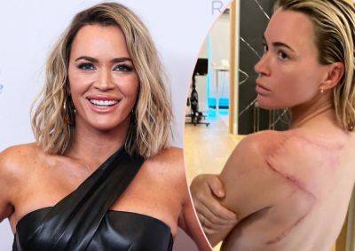 Teddi Mellencamp Shows Off Huge Scar After Melanoma Successfully Removed In Surgery! - perezhilton.com