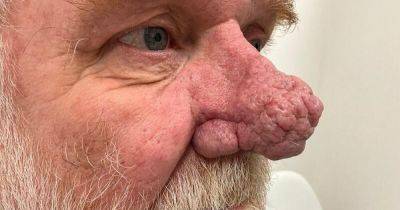 Man's amazing transformation after nose growth stopped him leaving the house in daylight - www.manchestereveningnews.co.uk - Scotland - Manchester - Turkey