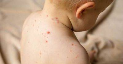Greater Manchester Police issue warning as 'childhood infections of measles and whooping cough are rising dramatically' - www.manchestereveningnews.co.uk - Britain - Manchester